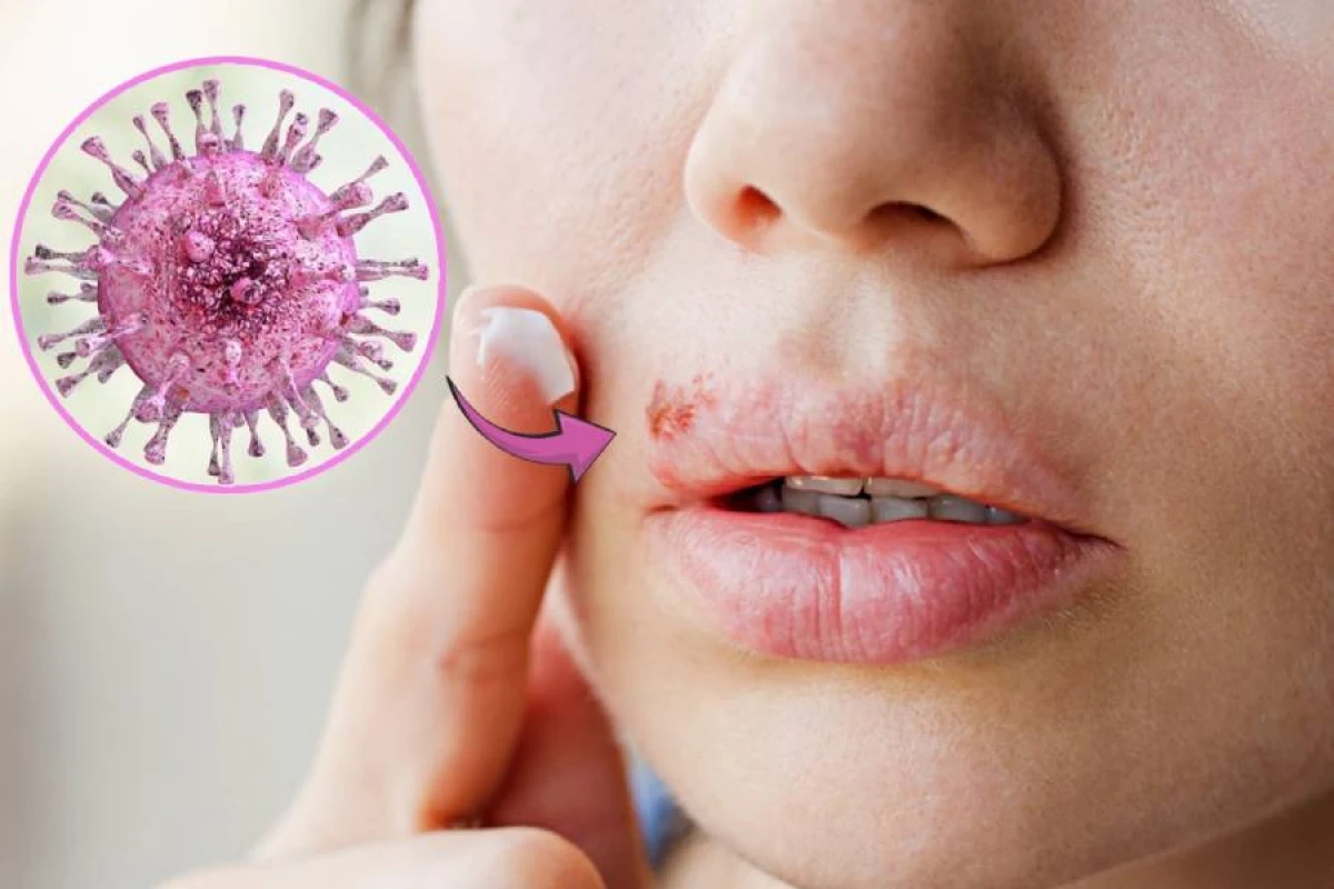 Dodaq herpesinə səbəb olan virus Alzheimer riskini artırır