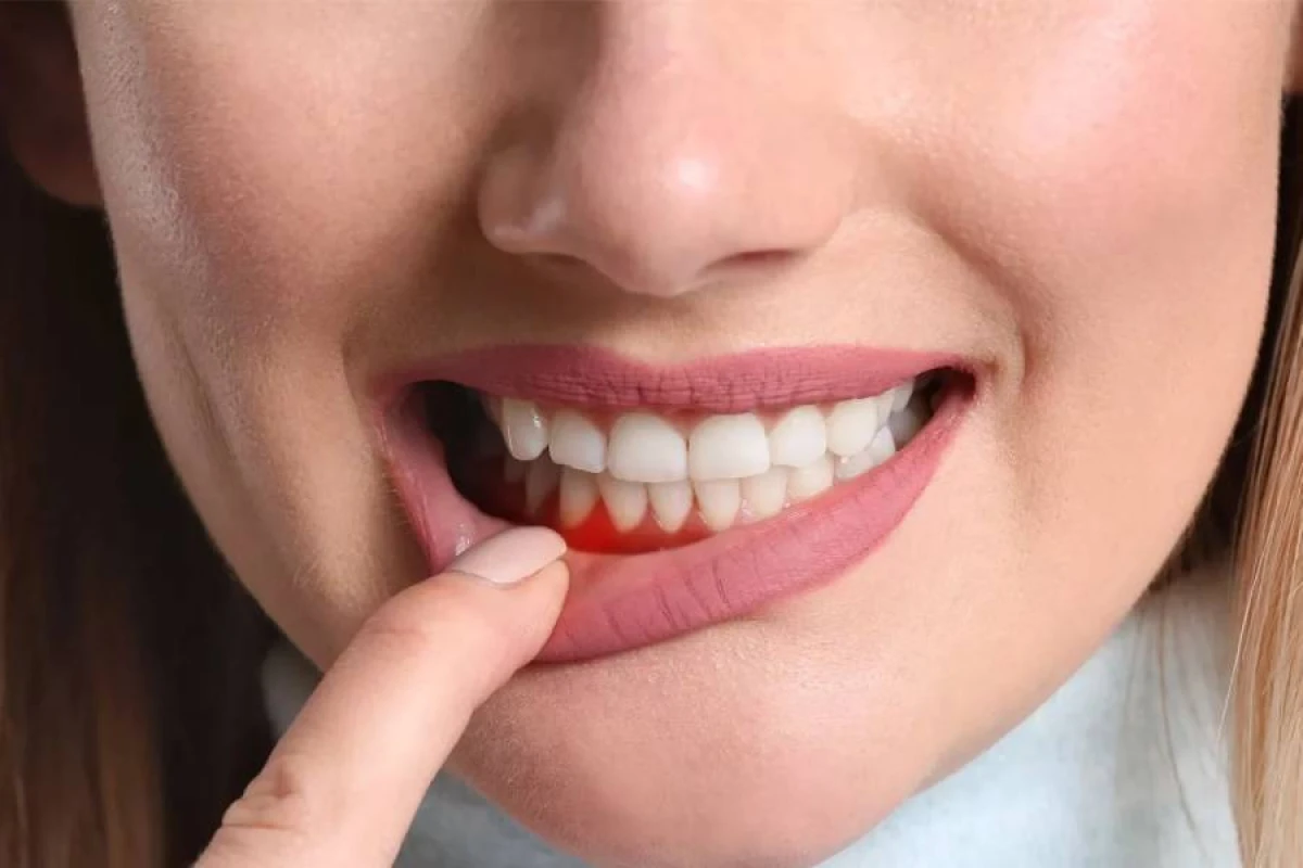 Diş əti qanamasına səbəb nədir?