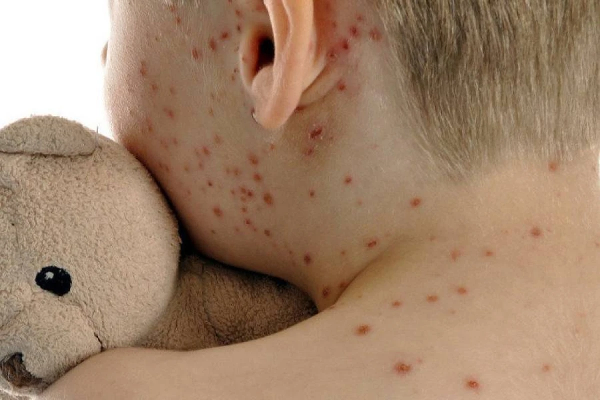 Monqolustanda qızılca epidemiyası sürətlə yayılır