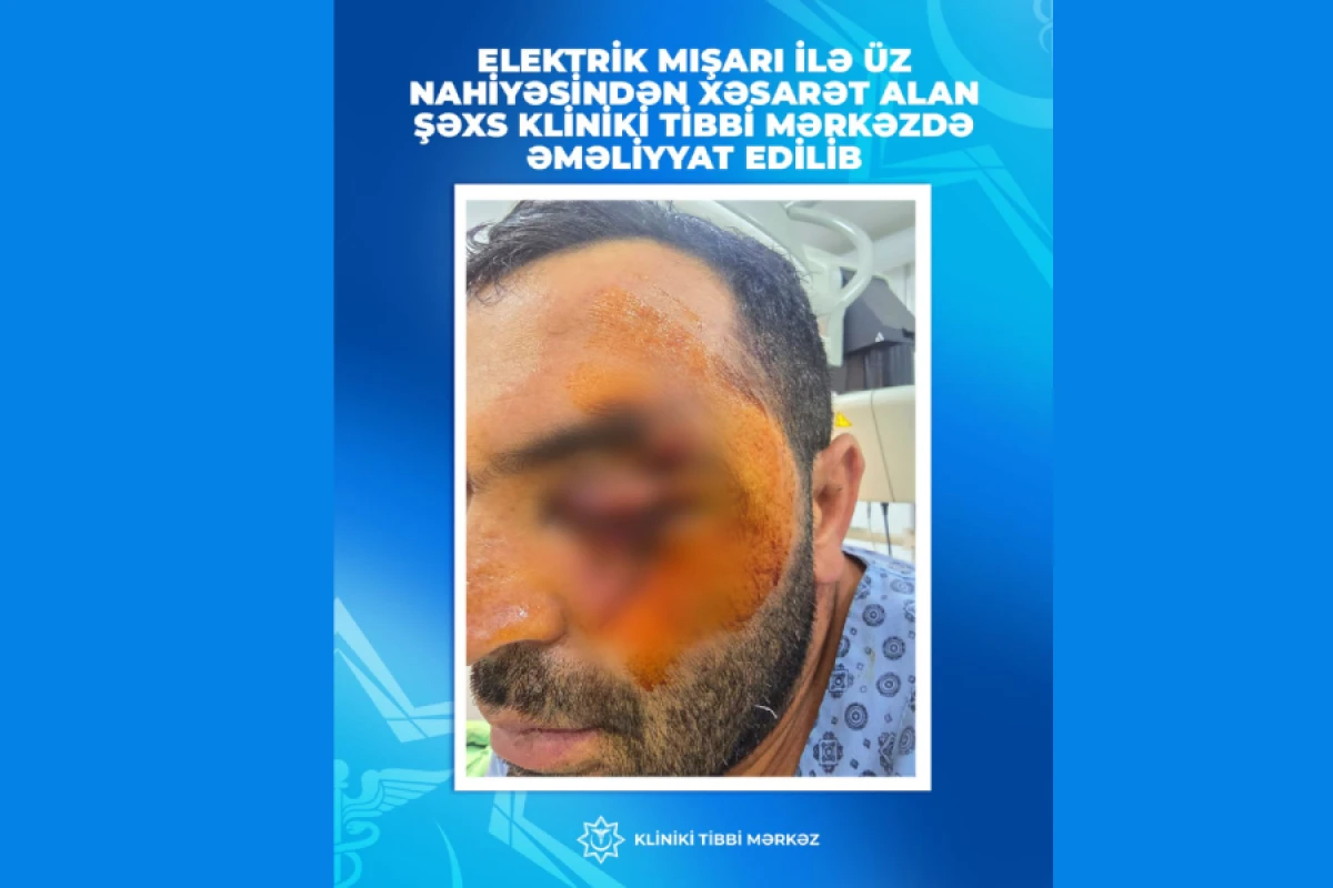 Üzünü elektrik mişarı ilə kəsmişdi, əməliyyat edildi