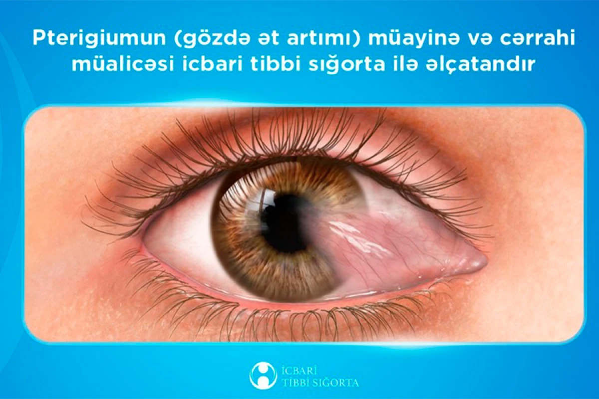 Gözdə ət artımı üzrə icra olunan əməliyyatların sayı açıqlandı