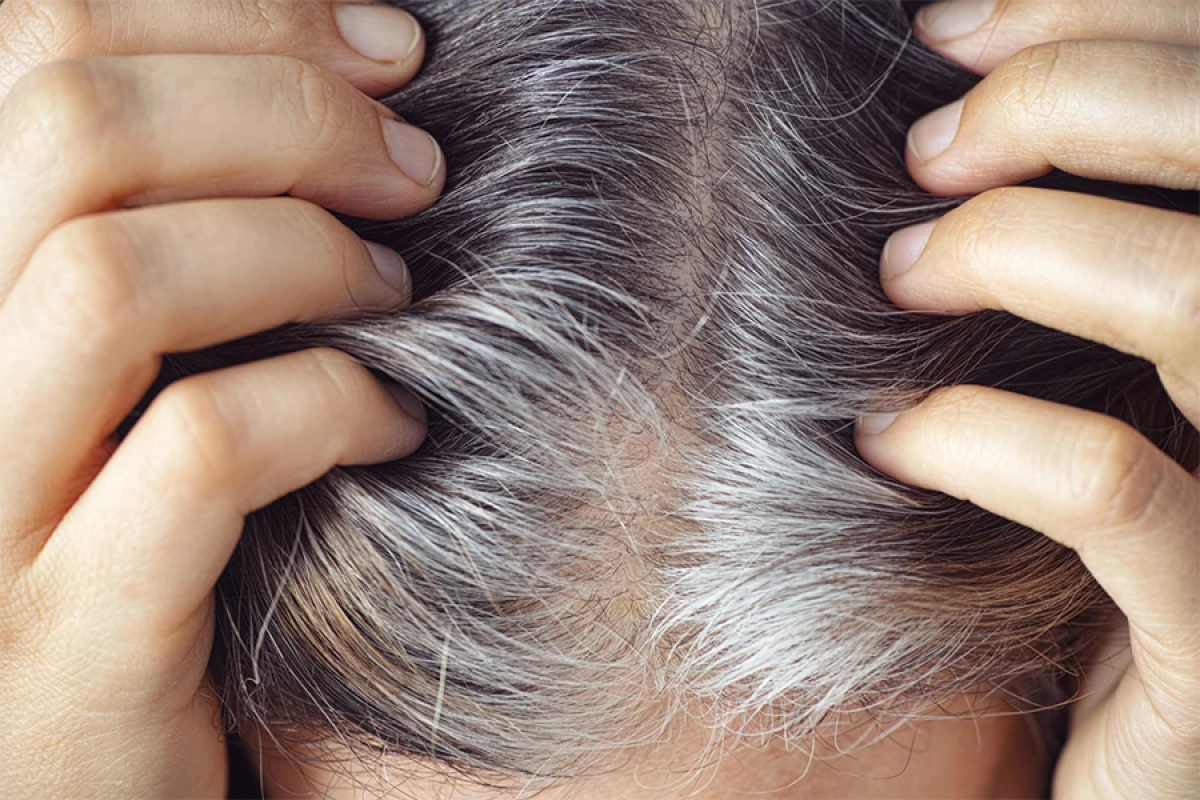 Gənclərdə saçların ağarması: Səbəb stressdir, yoxsa irsiyyət?