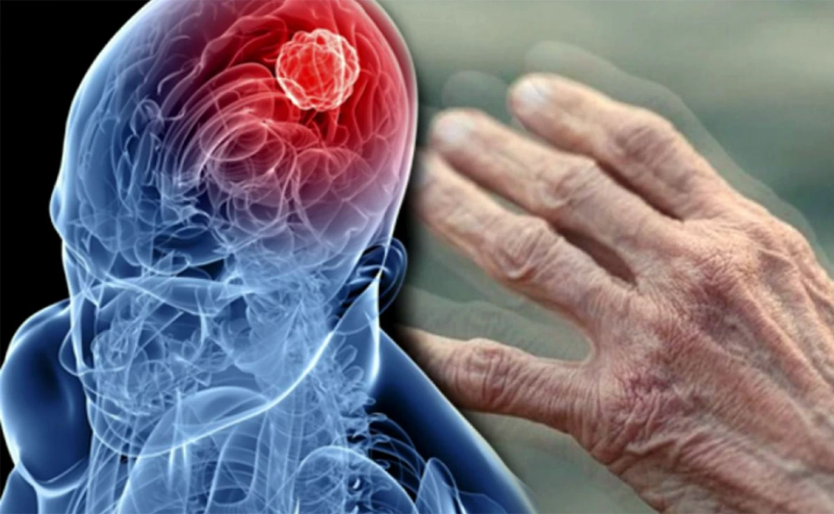 Parkinson xəstəliyinin ilk əlamətləri hansılardır?